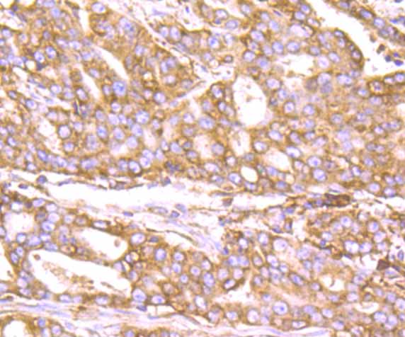 Paraformaldehyde-fixed and paraffin-embedded Human Stomach Cancer tissue incubated with KDELR1 (3A6) Monoclonal Antibody (bsm-54328R) at 1:200, overnight at 4°C, followed by a conjugated secondary antibody and DAB staining. Counterstained with hematoxylin.
