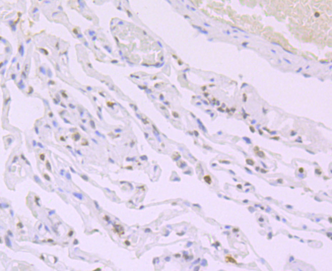 Paraformaldehyde-fixed and paraffin-embedded Human Lung Cancer tissue incubated with Histone H4 (acetyl K16) (2G2) Monoclonal Antibody (bsm-54330R) at 1:100, overnight at 4°C, followed by a conjugated secondary antibody and DAB staining. Counterstained with hematoxylin.
