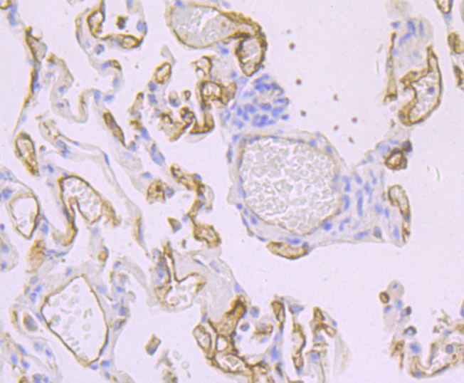 Paraformaldehyde-fixed and paraffin-embedded Human Lung Cancer tissue incubated with Thrombomodulin (3G7) Monoclonal Antibody (bsm-54333R) at 1:100, overnight at 4°C, followed by a conjugated secondary antibody and DAB staining. Counterstained with hematoxylin.