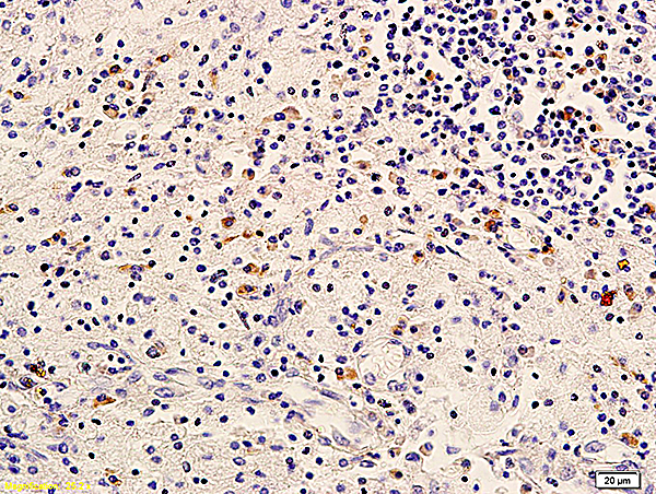 Formalin-fixed and paraffin embedded human cervical carcinoma labeled with Anti-ErbB-3/HER3 Polyclonal Antibody, Unconjugated (bs-1454R) followed by conjugation to the secondary antibody and DAB staining Formalin-fixed and paraffin embedded human cervical carcinoma labeled with Anti-ErbB-3/HER3 Polyclonal Antibody, Unconjugated (bs-1454R) followed by conjugation to the secondary antibody and DAB staining