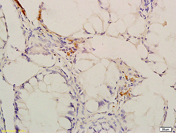 Formalin-fixed and paraffin embedded human colon carcinoma labeled with Anti-Phospho-CaMKII (Thr286) Polyclonal Antibody, Unconjugated (bs-1647R) at 1:200 followed by conjugation to the secondary antibody and DAB staining. Formalin-fixed and paraffin embedded human colon carcinoma labeled with Anti-Phospho-CaMKII (Thr286) Polyclonal Antibody, Unconjugated (bs-1647R) at 1:200 followed by conjugation to the secondary antibody and DAB staining.