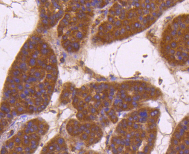 Paraformaldehyde-fixed and paraffin-embedded Human liver cancer tissue incubated with CD13 (3C11) Monoclonal Antibody (bsm-52528R) at 1:100, overnight at 4°C, followed by a conjugated secondary antibody and DAB staining. Counterstained with hematoxylin.