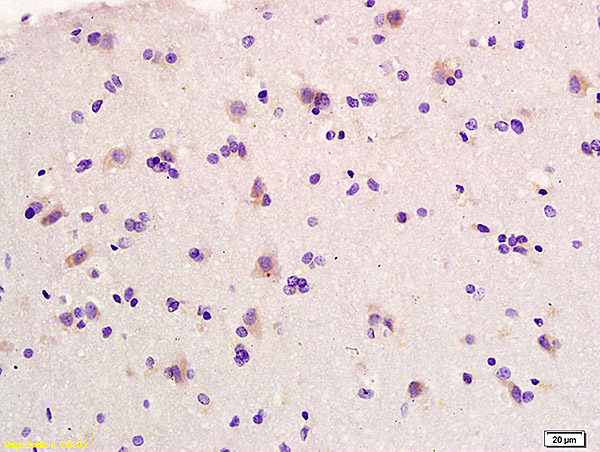 Formalin-fixed and paraffin embedded human glioma labeled with Anti-Elastin Polyclonal Antibody, Unconjugated (bs-1756R) at 1:200 followed by conjugation to the secondary antibody and DAB staining.