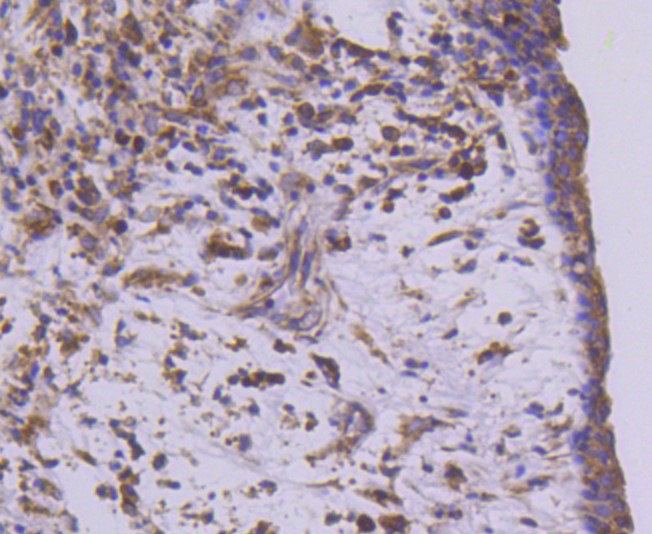 Paraformaldehyde-fixed and paraffin-embedded Human breast carcinoma tissue incubated with MEKK2 (9A2) Monoclonal Antibody (bsm-52540R) at 1:100, overnight at 4°C, followed by a conjugated secondary antibody and DAB staining. Counterstained with hematoxylin.