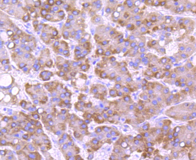 Paraformaldehyde-fixed and paraffin-embedded Human liver cancer tissue incubated with CYP2E1 (1A26) Monoclonal Antibody (bsm-52923R) at 1:100, overnight at 4°C, followed by a conjugated secondary antibody and DAB staining. Counterstained with hematoxylin.