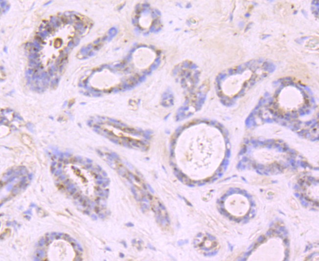 Paraformaldehyde-fixed and paraffin-embedded Human breast cancer tissue incubated with Growth Hormone (1C1) Monoclonal Antibody (bsm-52922R) at 1:100, overnight at 4°C, followed by a conjugated secondary antibody and DAB staining. Counterstained with hematoxylin. Paraformaldehyde-fixed and paraffin-embedded Human breast cancer tissue incubated with Growth Hormone (1C1) Monoclonal Antibody (bsm-52922R) at 1:100, overnight at 4°C, followed by a conjugated secondary antibody and DAB staining. Counterstained with hematoxylin.
