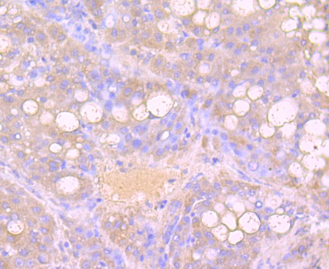 Paraformaldehyde-fixed and paraffin-embedded Human liver cancer tissue incubated with Growth Hormone (1C1) Monoclonal Antibody (bsm-52922R) at 1:100, overnight at 4°C, followed by a conjugated secondary antibody and DAB staining. Counterstained with hematoxylin. Paraformaldehyde-fixed and paraffin-embedded Human liver cancer tissue incubated with Growth Hormone (1C1) Monoclonal Antibody (bsm-52922R) at 1:100, overnight at 4°C, followed by a conjugated secondary antibody and DAB staining. Counterstained with hematoxylin.