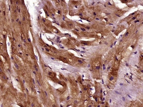 Paraformaldehyde-fixed, paraffin-embedded Human Myocardial tissue; Antigen retrieval by boiling in sodium citrate buffer (0.01M, pH6) for 15 minutes; Block endogenous peroxidase by 3% hydrogen peroxide for 30 minutes; Blocking buffer (normal goat serum) at 37°C for 20 minutes; Antibody incubation with Pan-Tropomyosin Polyclonal Antibody, Unconjugated (bs-9622R) at 1:400 overnight at 4°C, followed by incubation with a conjugated secondary antibody, DAB and counterstaining. Paraformaldehyde-fixed, paraffin-embedded Human Myocardial tissue; Antigen retrieval by boiling in sodium citrate buffer (0.01M, pH6) for 15 minutes; Block endogenous peroxidase by 3% hydrogen peroxide for 30 minutes; Blocking buffer (normal goat serum) at 37°C for 20 minutes; Antibody incubation with Pan-Tropomyosin Polyclonal Antibody, Unconjugated (bs-9622R) at 1:400 overnight at 4°C, followed by incubation with a conjugated secondary antibody, DAB and counterstaining.