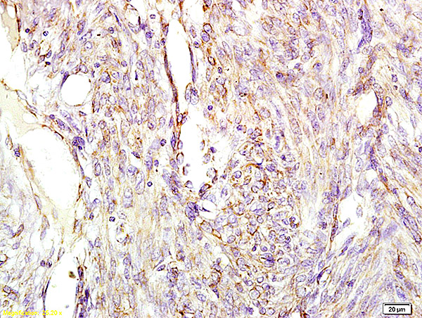 Formalin-fixed and paraffin embedded human cervical carcinoma labeled with Anti-CGA\/ Chromogranin A Polyclonal Antibody, Unconjugated (bs-0539R) at 1:200 followed by conjugation to the secondary antibody and DAB staining