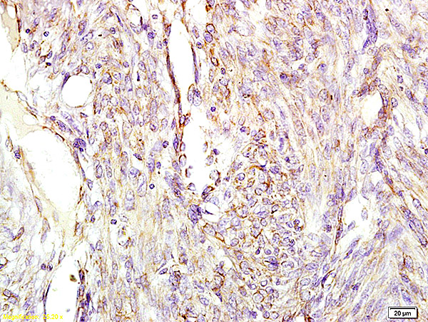 Formalin-fixed and paraffin embedded human cervical carcinoma labeled with Anti-CGA/ Chromogranin A Polyclonal Antibody, Unconjugated (bs-0539R) at 1:200 followed by conjugation to the secondary antibody and DAB staining