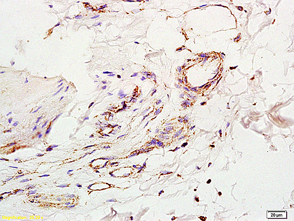 Formalin-fixed and paraffin embedded human colon carcinoma labeled with Anti-IL-2 Polyclonal Antibody, Unconjugated (bs-0605R) at 1:200 followed by conjugation to the secondary antibody and DAB staining