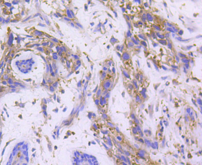 Paraformaldehyde-fixed and paraffin-embedded Human breast carcinoma tissue incubated with RALBP1 (36H1) Monoclonal Antibody (bsm-52559R) at 1:100, overnight at 4°C, followed by a conjugated secondary antibody and DAB staining. Counterstained with hematoxylin.