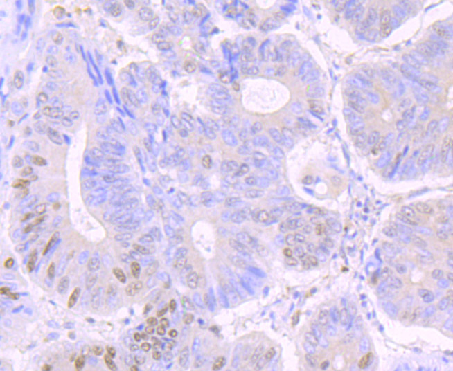 Paraformaldehyde-fixed and paraffin-embedded Human Colon Cancer tissue incubated with CREB1 (Ser133) (5F2) Monoclonal Antibody (bsm-54334R) at 1:100, overnight at 4°C, followed by a conjugated secondary antibody and DAB staining. Counterstained with hematoxylin.