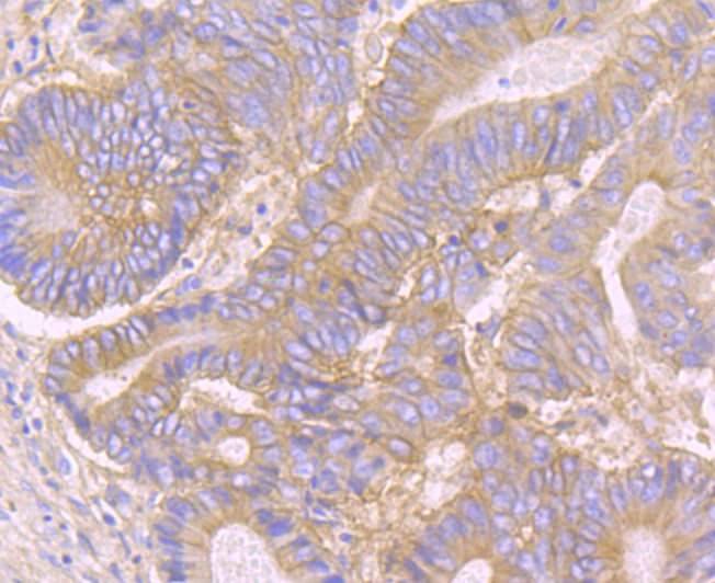 Paraformaldehyde-fixed and paraffin-embedded Human Colon Cancer tissue incubated with CD46 (4C3) Monoclonal Antibody (bsm-54335R) at 1:100, overnight at 4°C, followed by a conjugated secondary antibody and DAB staining. Counterstained with hematoxylin.
