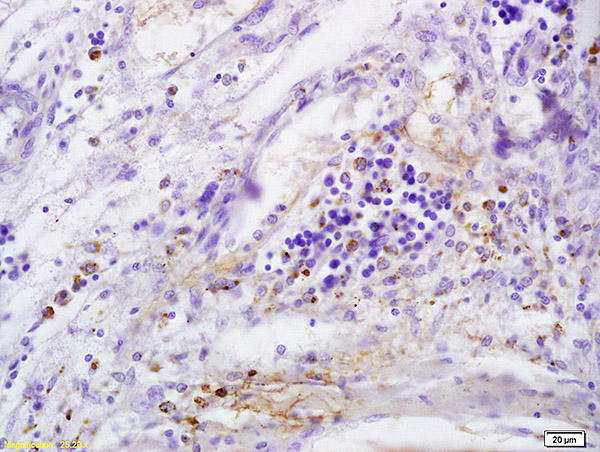 Formalin-fixed and paraffin embedded human cervical carcinoma labeled with Anti-CD146\/MCAM Polyclonal Antibody, Unconjugated (bs-1618R) at 1:200 followed by conjugation to the secondary antibody and DAB staining