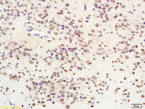 Formalin-fixed and paraffin embedded human glioma tissue labeled with Anti-SIRT1 Polyclonal Antibody, Unconjugated (bs-2257R) at 1:200 followed by conjugation to the secondary antibody and DAB staining