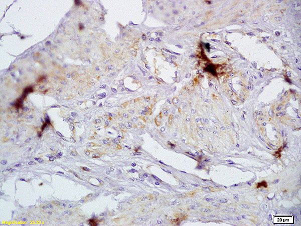 Formalin-fixed and paraffin embedded human cervical carcinoma labeled with Anti-CD72/Ly-32 Polyclonal Antibody, Unconjugated (bs-2517R) at 1:200 followed by conjugation to the secondary antibody and DAB staining