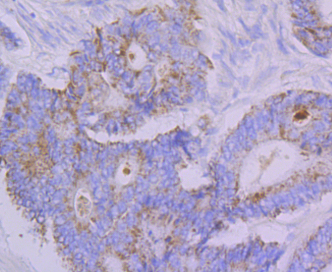 Paraformaldehyde-fixed and paraffin-embedded Human Colon Cancer tissue incubated with FBXO5 (4G10) Monoclonal Antibody (bsm-54356R) at 1:100, overnight at 4°C, followed by a conjugated secondary antibody and DAB staining. Counterstained with hematoxylin.