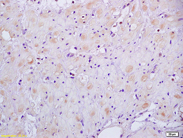 Formalin-fixed and paraffin embedded human gastric carcinoma labeled with Anti-HSD17B1 Polyclonal Antibody, Unconjugated (bs-3855R) at 1:200 followed by conjugation to the secondary antibody and DAB staining
