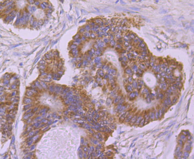 Paraformaldehyde-fixed and paraffin-embedded Human Colon Cancer tissue incubated with UQCRFS1 (10C1) Monoclonal Antibody (bsm-54363R) at 1:100, overnight at 4°C, followed by a conjugated secondary antibody and DAB staining. Counterstained with hematoxylin.