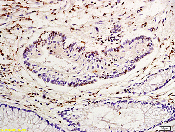Formalin-fixed and paraffin embedded human colon carcinoma labeled with Anti-Nucleophosmin Polyclonal Antibody, Unconjugated (bs-4757R) at 1:200 followed by conjugation to the secondary antibody and DAB staining