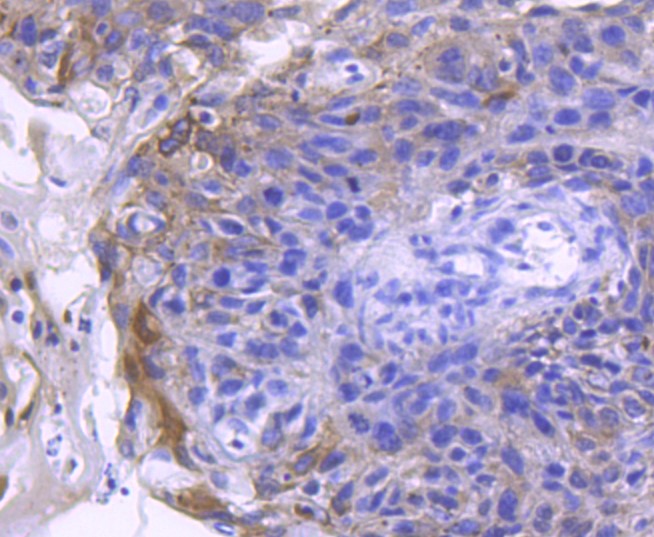 Paraformaldehyde-fixed and paraffin-embedded human breast carcinoma tissue incubated with Angiotensin Converting Enzyme 2 (3F1) Monoclonal Antibody (bsm-52614R) at 1:100, overnight at 4°C, followed by a conjugated secondary antibody and DAB staining. Counterstained with hematoxylin.