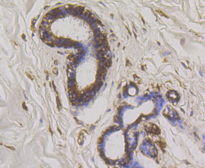 Paraformaldehyde-fixed and paraffin-embedded Human Breast Cancer tissue incubated with WNK1 (7C9) Monoclonal Antibody (bsm-54375R) at 1:100, overnight at 4°C, followed by a conjugated secondary antibody and DAB staining. Counterstained with hematoxylin.