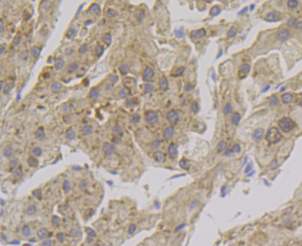 Paraformaldehyde-fixed and paraffin-embedded Human Liver tissue incubated with ADH1A (2G4) Monoclonal Antibody (bsm-54396R) at 1:100, overnight at 4°C, followed by a conjugated secondary antibody and DAB staining. Counterstained with hematoxylin.