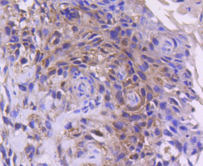 Paraformaldehyde-fixed and paraffin-embedded Human breast carcinoma tissue incubated with Cdk4 (6A4) Monoclonal Antibody (bsm-52651R) at 1:100, overnight at 4°C, followed by a conjugated secondary antibody and DAB staining. Counterstained with hematoxylin.