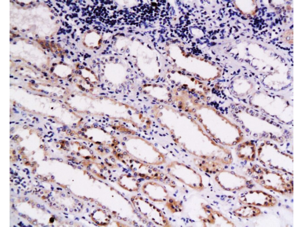 Formalin-fixed and paraffin embedded human kidney carcinoma labeled with Anti-Endostatin Polyclonal Antibody (bs-0547R), Unconjugated  at 1:200, followed by conjugation to the secondary antibody and DAB staining