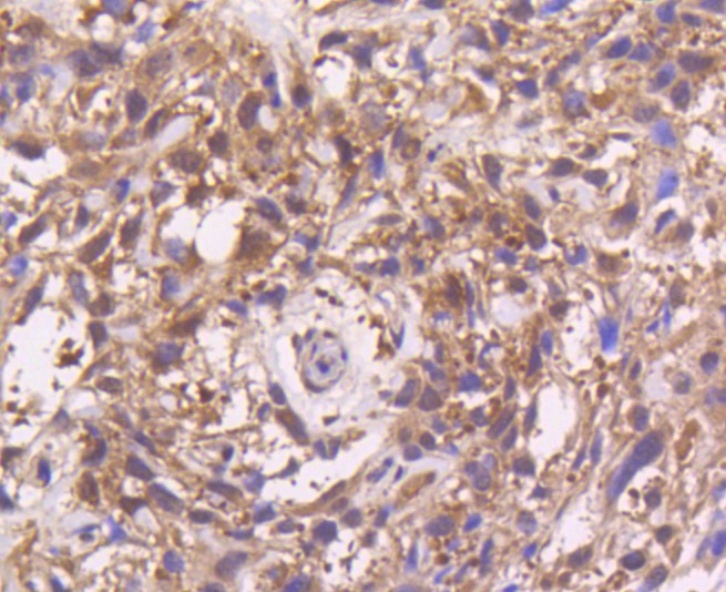 Paraformaldehyde-fixed and paraffin-embedded Human breast carcinoma tissue incubated with MEK3 (4C1) Monoclonal Antibody (bsm-52658R) at 1:100, overnight at 4°C, followed by a conjugated secondary antibody and DAB staining. Counterstained with hematoxylin.