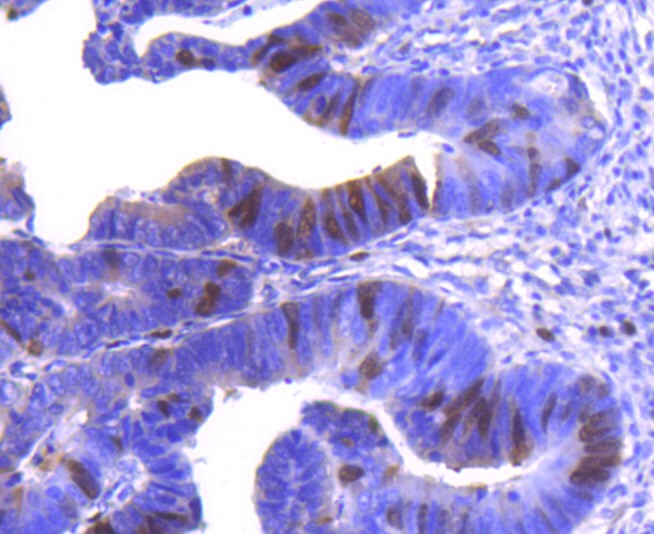 Paraformaldehyde-fixed and paraffin-embedded Human colon cancer tissue incubated with Cyclin A2 (2C2) Monoclonal Antibody (bsm-52660R) at 1:100, overnight at 4°C, followed by a conjugated secondary antibody and DAB staining. Counterstained with hematoxylin.