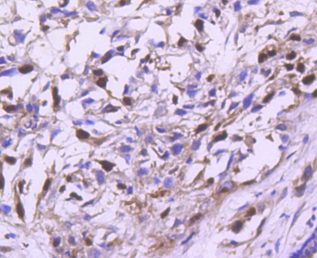 Paraformaldehyde-fixed and paraffin-embedded Human breast carcinoma tissue incubated with Cyclin A2 (2C2) Monoclonal Antibody (bsm-52660R) at 1:100, overnight at 4°C, followed by a conjugated secondary antibody and DAB staining. Counterstained with hematoxylin.