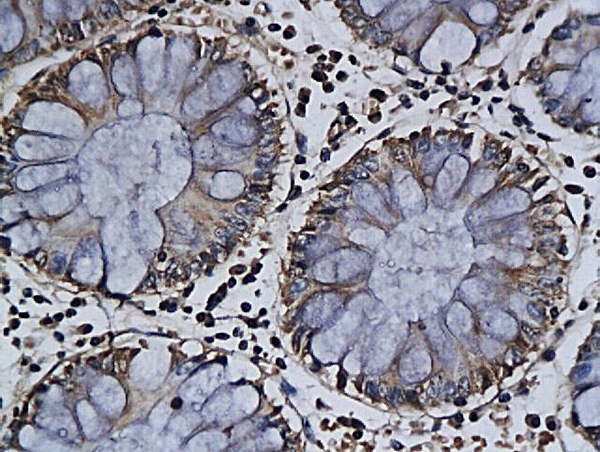 Formalin-fixed and paraffin embedded tumor tissue labeled with Anti-APOJ/Clusterin-αβ Polyclonal Antibody, Unconjugated (bs-1354R) followed by conjugation to the secondary antibody and DAB staining