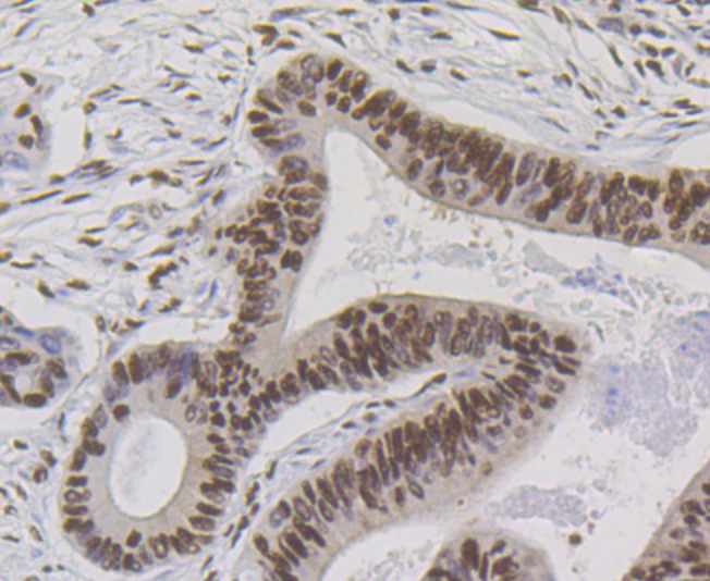 Paraformaldehyde-fixed and paraffin-embedded Human Colon Cancer tissue incubated with BUB3 (24D1) Monoclonal Antibody (bsm-54413R) at 1:100, overnight at 4°C, followed by a conjugated secondary antibody and DAB staining. Counterstained with hematoxylin.
