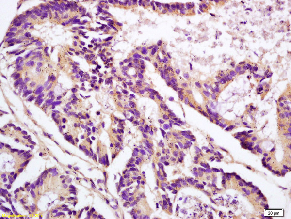 Formalin-fixed and paraffin embedded human colon carcinoma labeled with Anti-APOJ/Clusterin Polyclonal Antibody, Unconjugated (bs-1354R) at 1:200 followed by conjugation to the secondary antibody and DAB staining