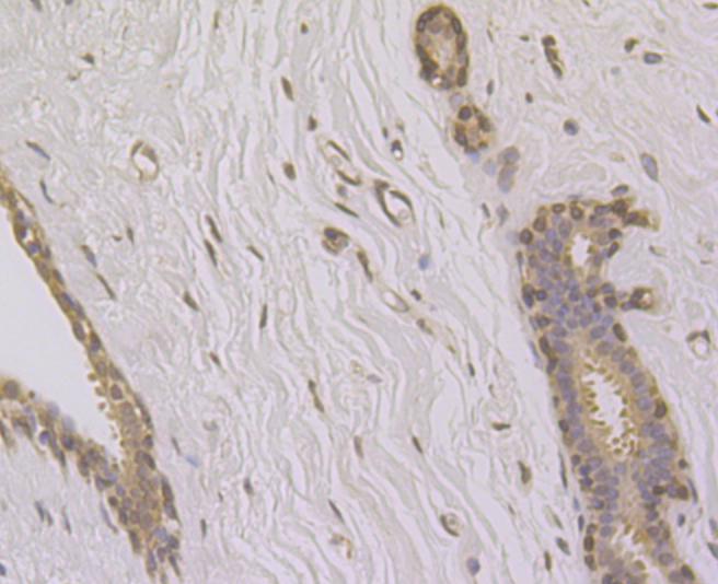 Paraformaldehyde-fixed and paraffin-embedded Human Breast tissue incubated with SUN1 (2C4) Monoclonal Antibody (bsm-54420R) at 1:100, overnight at 4°C, followed by a conjugated secondary antibody and DAB staining. Counterstained with hematoxylin.
