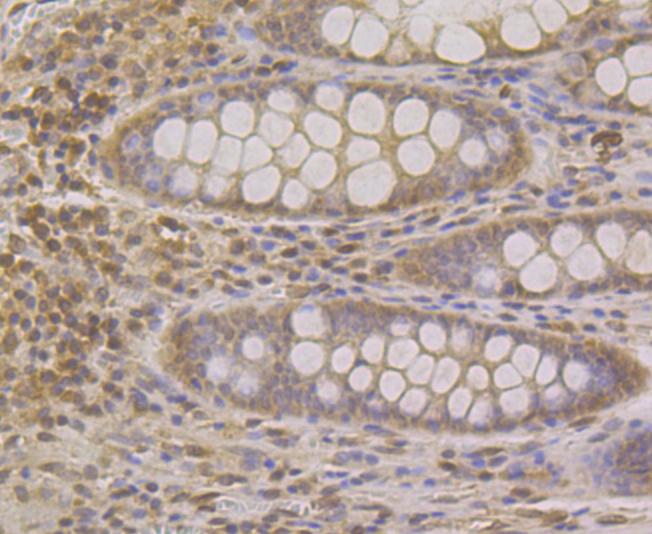Paraformaldehyde-fixed and paraffin-embedded Human Colon tissue incubated with SUN1 (2C4) Monoclonal Antibody (bsm-54420R) at 1:100, overnight at 4°C, followed by a conjugated secondary antibody and DAB staining. Counterstained with hematoxylin.