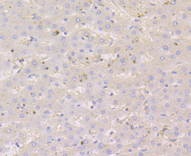 Paraformaldehyde-fixed and paraffin-embedded Human Liver Cancer tissue incubated with Nectin 2 (3G7) Monoclonal Antibody (bsm-54423R) at 1:100, overnight at 4°C, followed by a conjugated secondary antibody and DAB staining. Counterstained with hematoxylin.