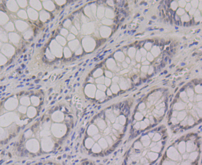 Paraformaldehyde-fixed and paraffin-embedded Human Colon tissue incubated with CTBP1 (3A12) Monoclonal Antibody (bsm-54424R) at 1:100, overnight at 4\u00b0C, followed by a conjugated secondary antibody and DAB staining. Counterstained with hematoxylin.