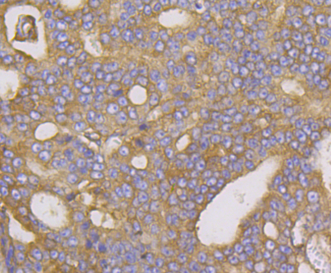 Paraformaldehyde-fixed and paraffin-embedded Human Prostate Cancer tissue incubated with Methionine Aminopeptidase 2 (2G3) Monoclonal Antibody (bsm-54425R) at 1:100, overnight at 4°C, followed by a conjugated secondary antibody and DAB staining. Counterstained with hematoxylin.