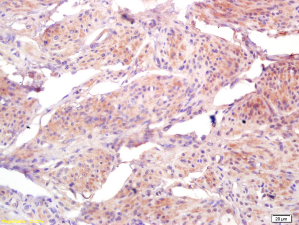 Formalin-fixed and paraffin embedded human cervical carcinoma labeled with Anti-HCCR1/BRI3BP Polyclonal Antibody, Unconjugated (bs-0402R) at 1:200 followed by conjugation to the secondary antibody and DAB staining
