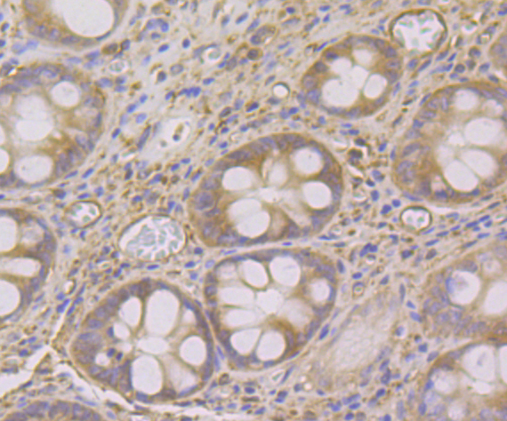 Paraformaldehyde-fixed and paraffin-embedded Human Colon Cancer tissue incubated with SNX1 (4C2) Monoclonal Antibody (bsm-54429R) at 1:100, overnight at 4°C, followed by a conjugated secondary antibody and DAB staining. Counterstained with hematoxylin.