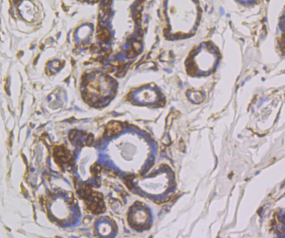 Paraformaldehyde-fixed and paraffin-embedded Human Breast Cancer tissue incubated with SNX1 (4C2) Monoclonal Antibody (bsm-54429R) at 1:100, overnight at 4°C, followed by a conjugated secondary antibody and DAB staining. Counterstained with hematoxylin.