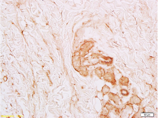 Formalin-fixed and paraffin embedded human skin labeled with Anti-Collagen-VI-alpha1 Polyclonal Antibody (bs-0553R), Unconjugated at 1:100, followed by conjugation to the secondary antibody and DAB staining