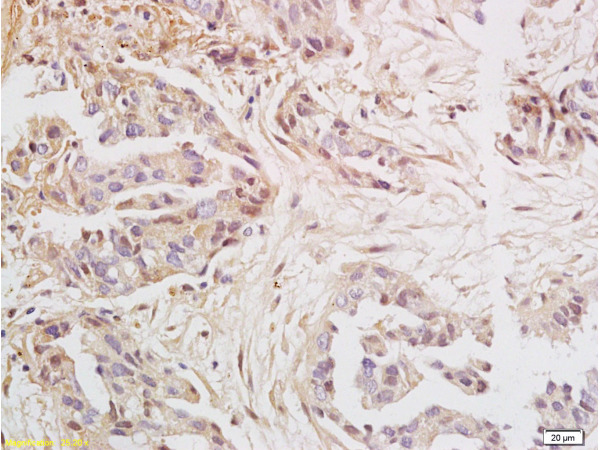 Formalin-fixed and paraffin embedded human ovary carcinoma labeled with Anti-HMGA2 Polyclonal Antibody (bs-0556R), Unconjugated at 1:200, followed by conjugation to the secondary antibody and DAB staining