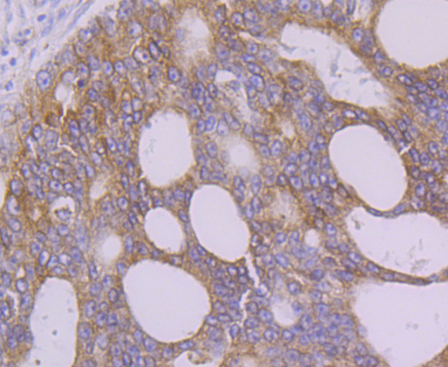 Paraformaldehyde-fixed and paraffin-embedded Human Prostate Cancer tissue incubated with FAAH (9C3) Monoclonal Antibody (bsm-54433R) at 1:100, overnight at 4°C, followed by a conjugated secondary antibody and DAB staining. Counterstained with hematoxylin.