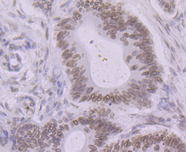 Paraformaldehyde-fixed and paraffin-embedded Human Colon Cancer tissue incubated with BANF1 (11H3) Monoclonal Antibody (bsm-54435R) at 1:100, overnight at 4°C, followed by a conjugated secondary antibody and DAB staining. Counterstained with hematoxylin. Paraformaldehyde-fixed and paraffin-embedded Human Colon Cancer tissue incubated with BANF1 (11H3) Monoclonal Antibody (bsm-54435R) at 1:100, overnight at 4°C, followed by a conjugated secondary antibody and DAB staining. Counterstained with hematoxylin.