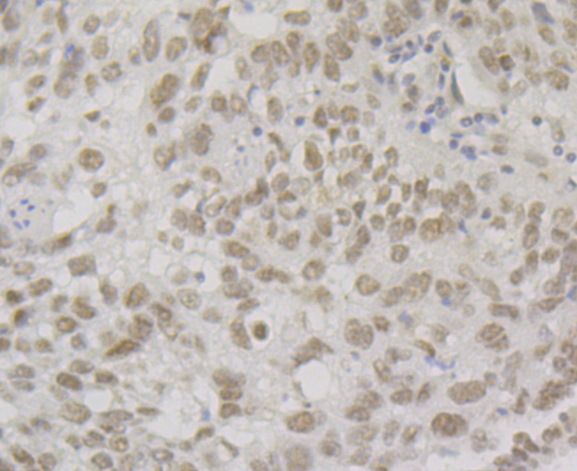 Paraformaldehyde-fixed and paraffin-embedded Human Lung Cancer tissue incubated with SMARCE1 (4D2) Monoclonal Antibody (bsm-54449R) at 1:100, overnight at 4°C, followed by a conjugated secondary antibody and DAB staining. Counterstained with hematoxylin.
