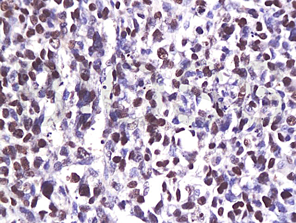 Formalin-fixed and paraffin embedded human breast carcinoma labeled with Anti-CDK6 Polyclonal Antibody (bs-0568R), Unconjugated at 1:200, followed by conjugation to the secondary antibody and DAB staining